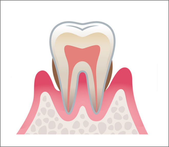 中等度の歯周病